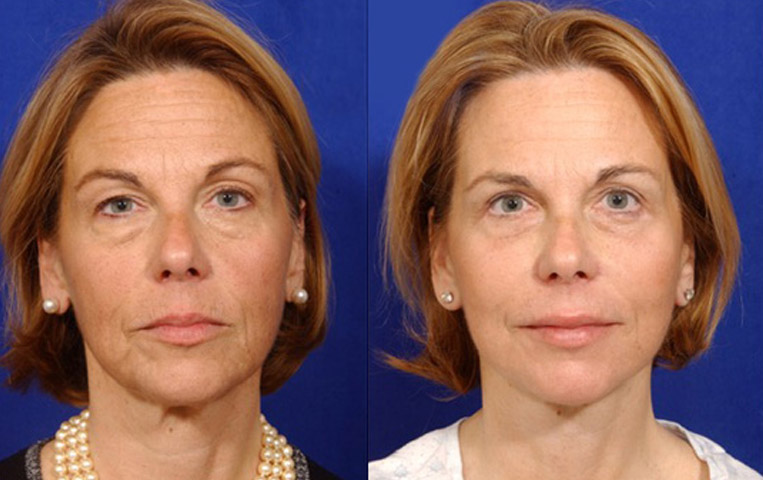 Facelift with Necklace, USIC Cheeklift, Lateral Browlift, Livefill to Naso Labial Folds and Lips, Upper Lip Lift, Rhinoplasty, Co2 to Face and Neck