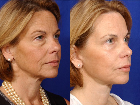 Facelift with Necklace, Lateral Browlift, USIC Cheeklift with Transconjunctival Lower Blepharoplasty, Livefill to Lips, Livefill to Nasolabial Folds, Co2 to Face and Neck