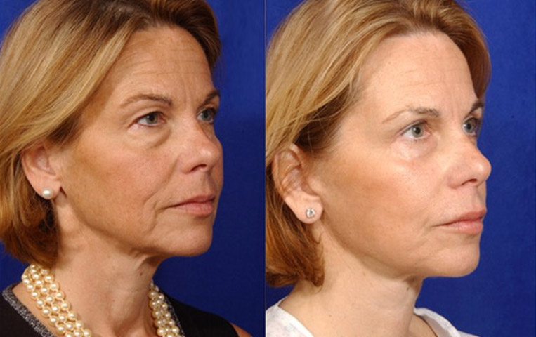 Facelift with Necklace, USIC Cheeklift, Lateral Browlift, Livefill to Naso Labial Folds and Lips, Upper Lip Lift, Rhinoplasty, Co2 to Face and Neck