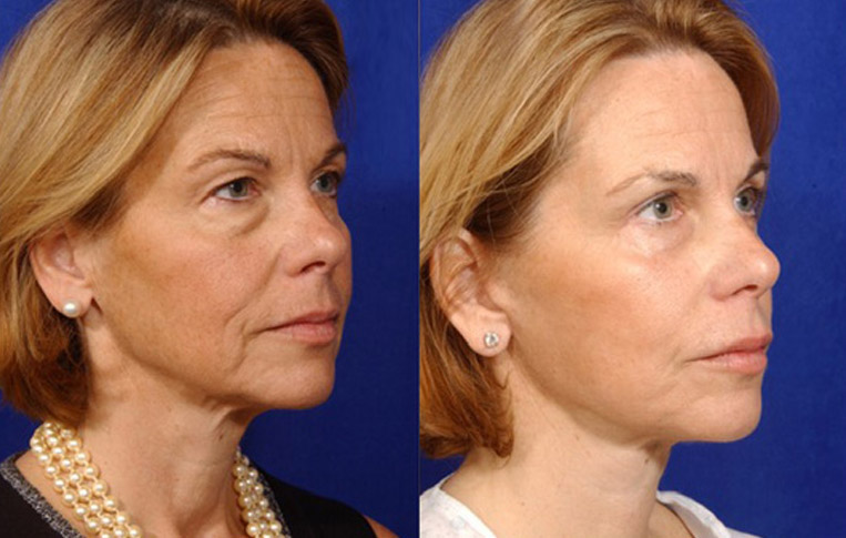 Facelift with Necklace, Lateral Browlift, USIC Cheeklift with Transconjunctival Lower Blepharoplasty, Livefill to Lips, Livefill to Nasolabial Folds, Co2 Laser to Face