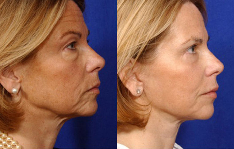 Facelift with Necklace, Lateral Browlift, USIC Cheeklift with Transconjunctival Lower Blepharoplasty, Livefill to Lips, Livefill to Nasolabial Folds, Co2