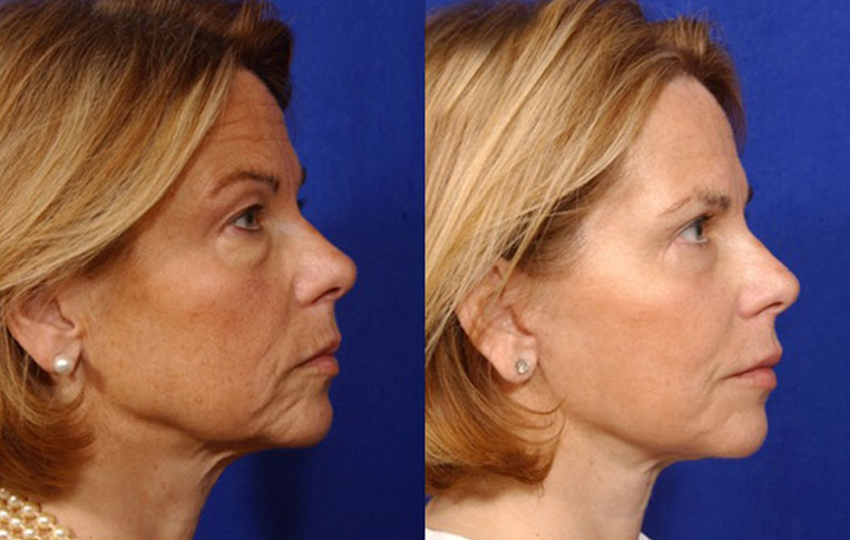 Facelift with Necklace, Lateral Browlift, USIC Cheeklift with Transconjunctival Lower Blepharoplasty, Livefill to Lips, Livefill to Nasolabial Folds, Co2 Laser to Face