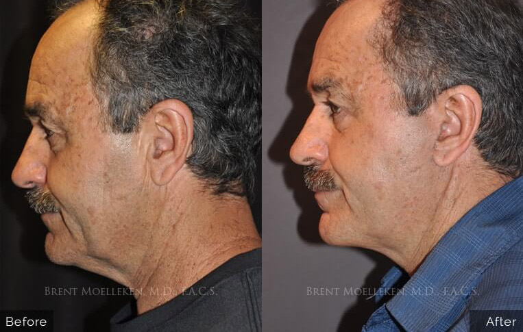 Facelift with Necklace, Upper Blepharoplasty, Livefill to Glabella, Lateral Browlift