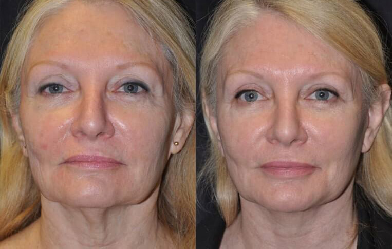 Facelift with Necklace © and upper blepharoplasty.