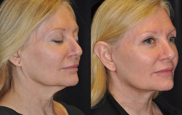 Facelift with Necklace © and upper blepharoplasty.