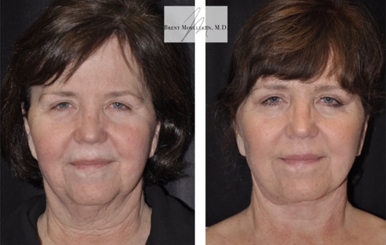 Facelift with Necklace, Earlobe Revision, Livefill to Lips, USIC Cheeklift, Upper Blepharoplasty