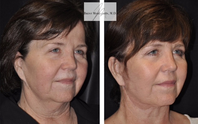 Facelift with Necklace, Earlobe Revision, Livefill to Lips, USIC Cheeklift, Upper Blepharoplasty