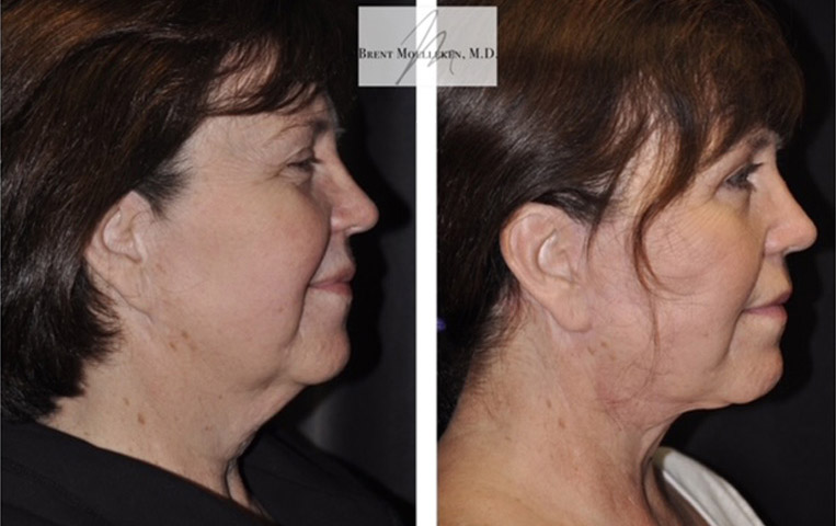 Facelift with Necklace, Earlobe Revision, Livefill to Lips, USIC Cheeklift, Upper Blepharoplasty