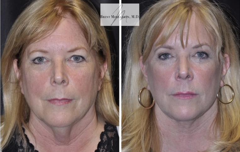 Facelift with Necklace, Lateral Browlift, USIC Cheeklift, Transconjunctival Lower Blepharoplasty, Co2 Laser to Face