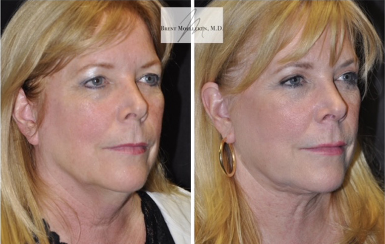 Facelift with Necklace, Lateral Browlift, USIC Cheeklift, Transconjunctival Lower Blepharoplasty, Co2 Laser to Face