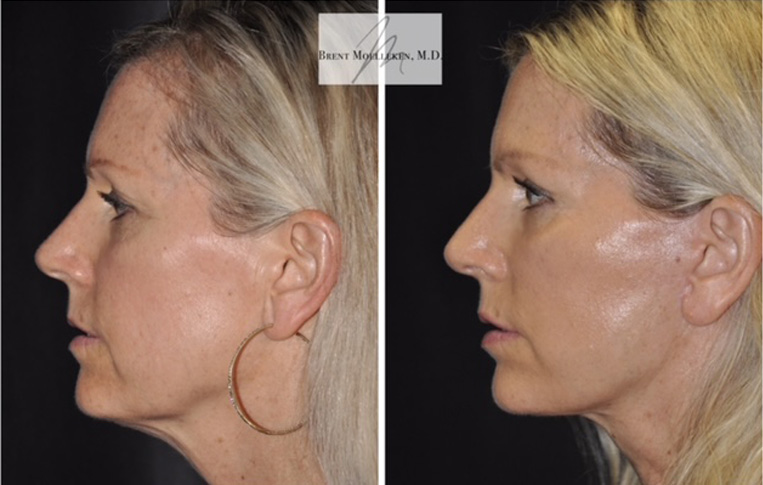 Facelift with Necklace, USIC Cheeklift, Upper Blepharoplasty, Livefill to Nasolabial Folds and Lips, Upper Lip Lift, Co2 Laser to Face, Rhinoplasty