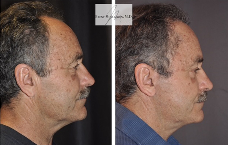 Facelift with Necklace, Upper Blepharoplasty, Livefill to Glabella, Lateral Browlift