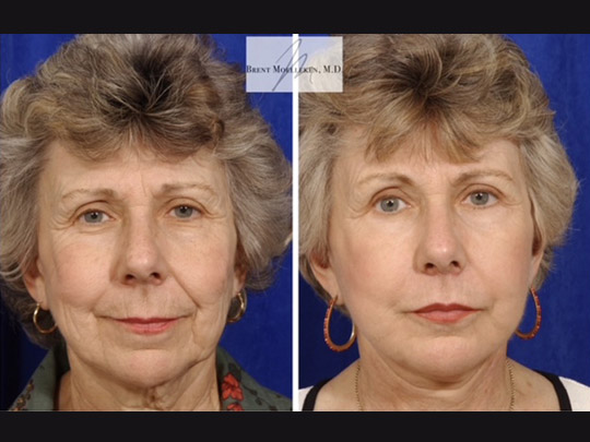 Facelift with Necklace, USIC Cheeklift, Upper Blepharoplasty, Lateral Browlift, Livefill to Nasolabial Folds and Lips, Upper Lip Lift, Co2 Laser Resurfacing