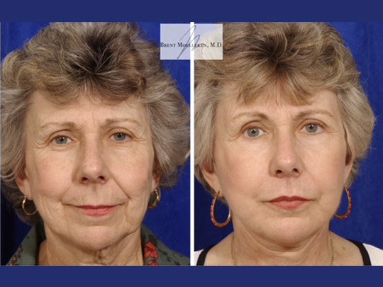 Facelift with Necklace, USIC Cheeklift, Upper Blepharoplasty, Lateral Browlift, Livefill to Nasolabial Folds and Lips, Upper Lip Lift, Co2 Laser Resurfacing