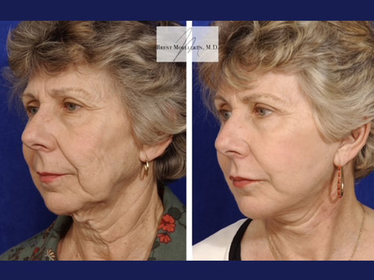 Facelift with Necklace, USIC Cheeklift, Upper Blepharoplasty, Lateral Browlift, Livefill to Nasolabial Folds and Lips, Upper Lip Lift, Co2 Laser Resurfacing