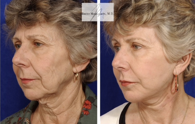 Facelift with Necklace, USIC Cheeklift, Upper Blepharoplasty, Lateral Browlift, Livefill to Nasolabial Folds and Lips, Upper Lip Lift, Co2 Laser Resurfacing