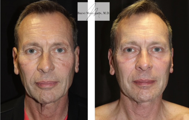 Facelift, Necklace, Co2 Laser to Face