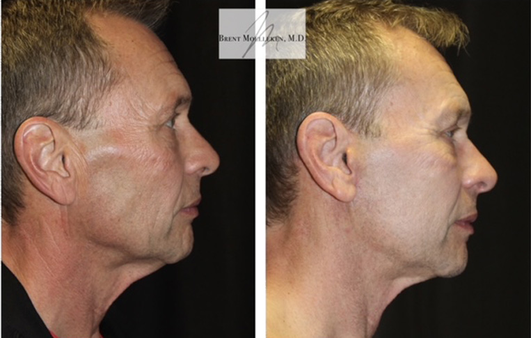 Facelift, Necklace, Co2 Laser to Face