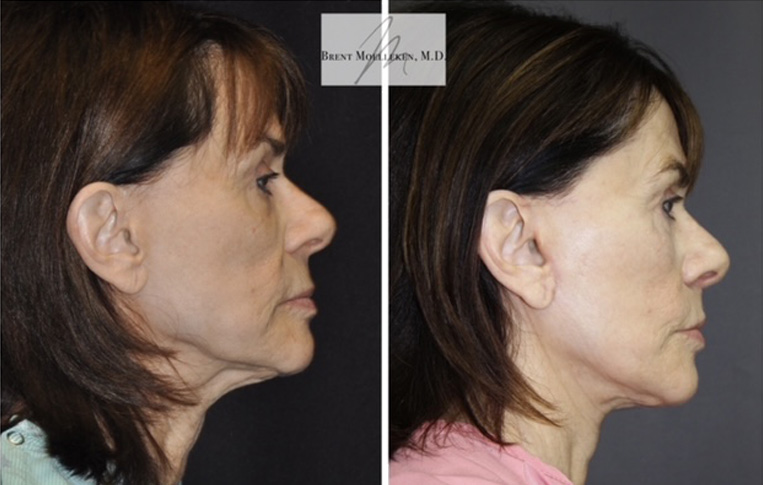 Facelift with Necklace, USIC Cheeklift, Upper Blepharoplasty, Livefill to Lips, Livefill to Cheeks, Gullwing Lip Lift, Co2 Laser to Face