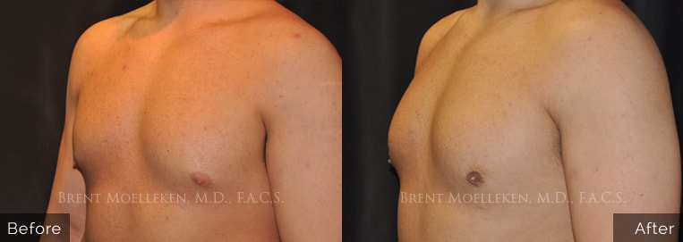 30 yr old male Gynecomastia/ Liposuction to chest Surgery