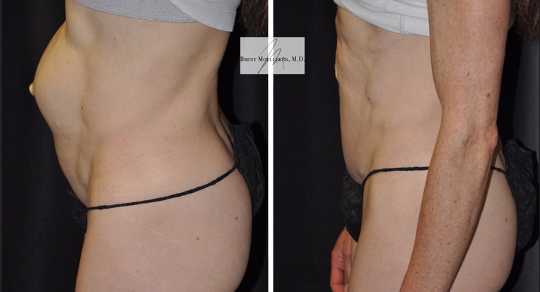 Hybrid Tummy Tuck with Diastasis and Hernia Repair