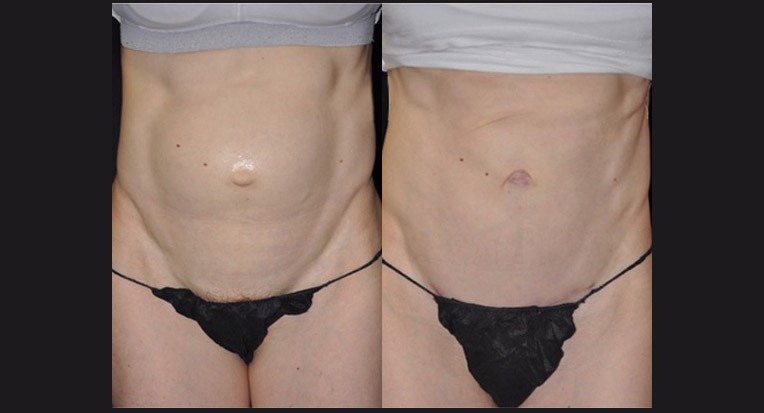 Hybrid Tummy Tuck with Diastasis and Hernia Repair