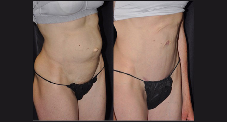 Hybrid Tummy Tuck with Diastasis and Hernia Repair