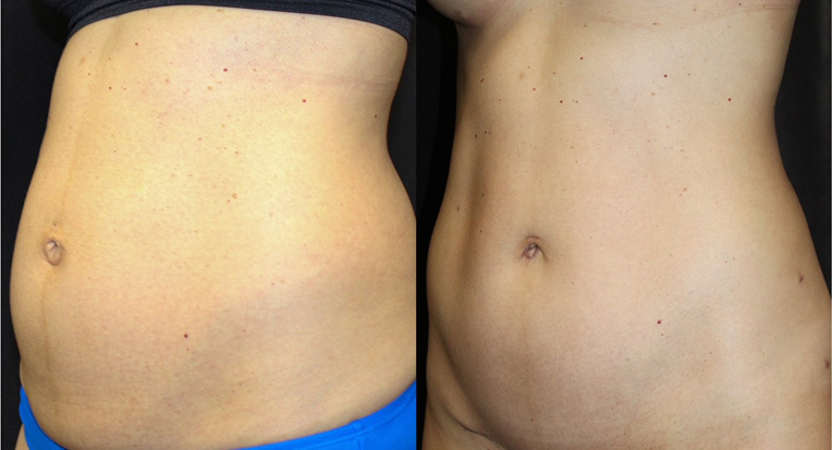 Hybrid Tummy Tuck